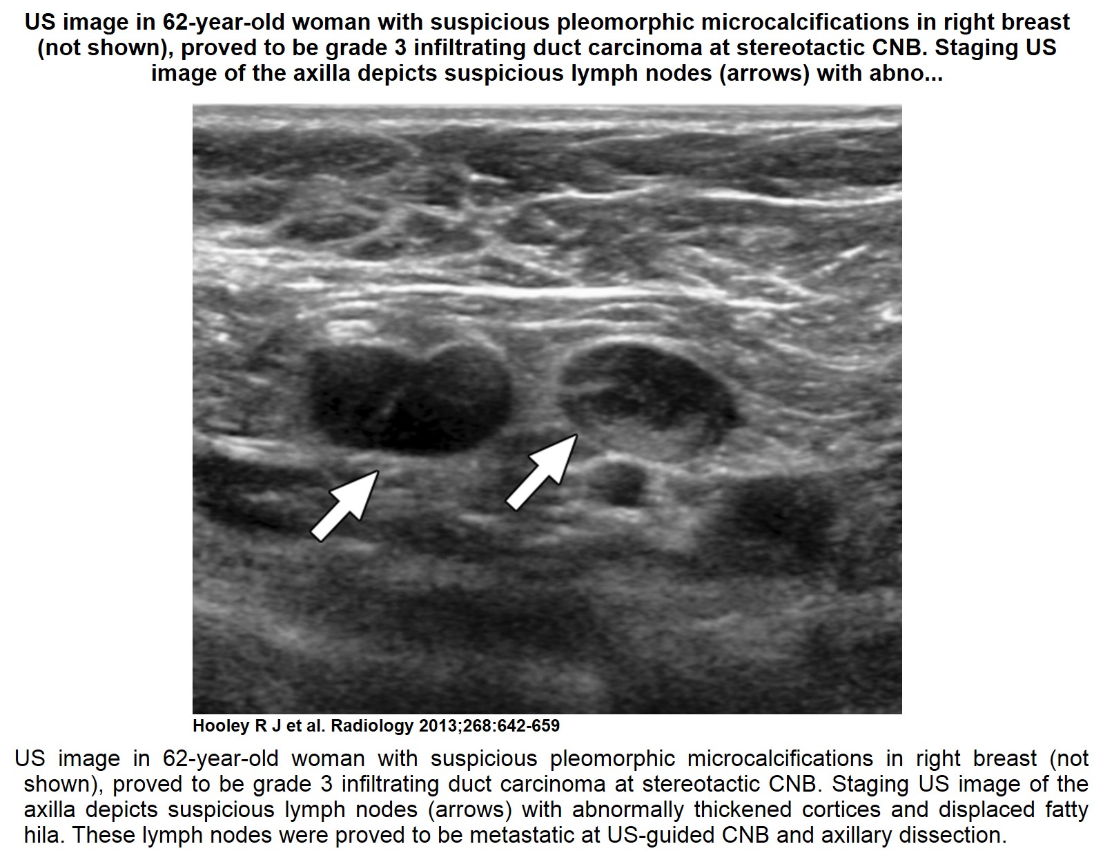 Recent comprehensive review on the role of ultrasound in breast cancer management  Leaders in 